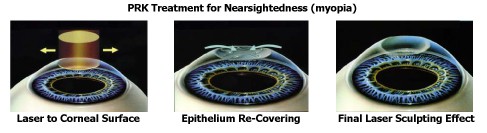 PRK Treatment for Nearsightedness