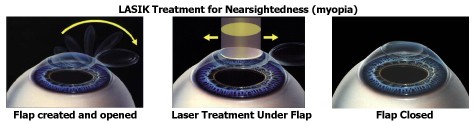 LASIK Treatment for Nearsightedness